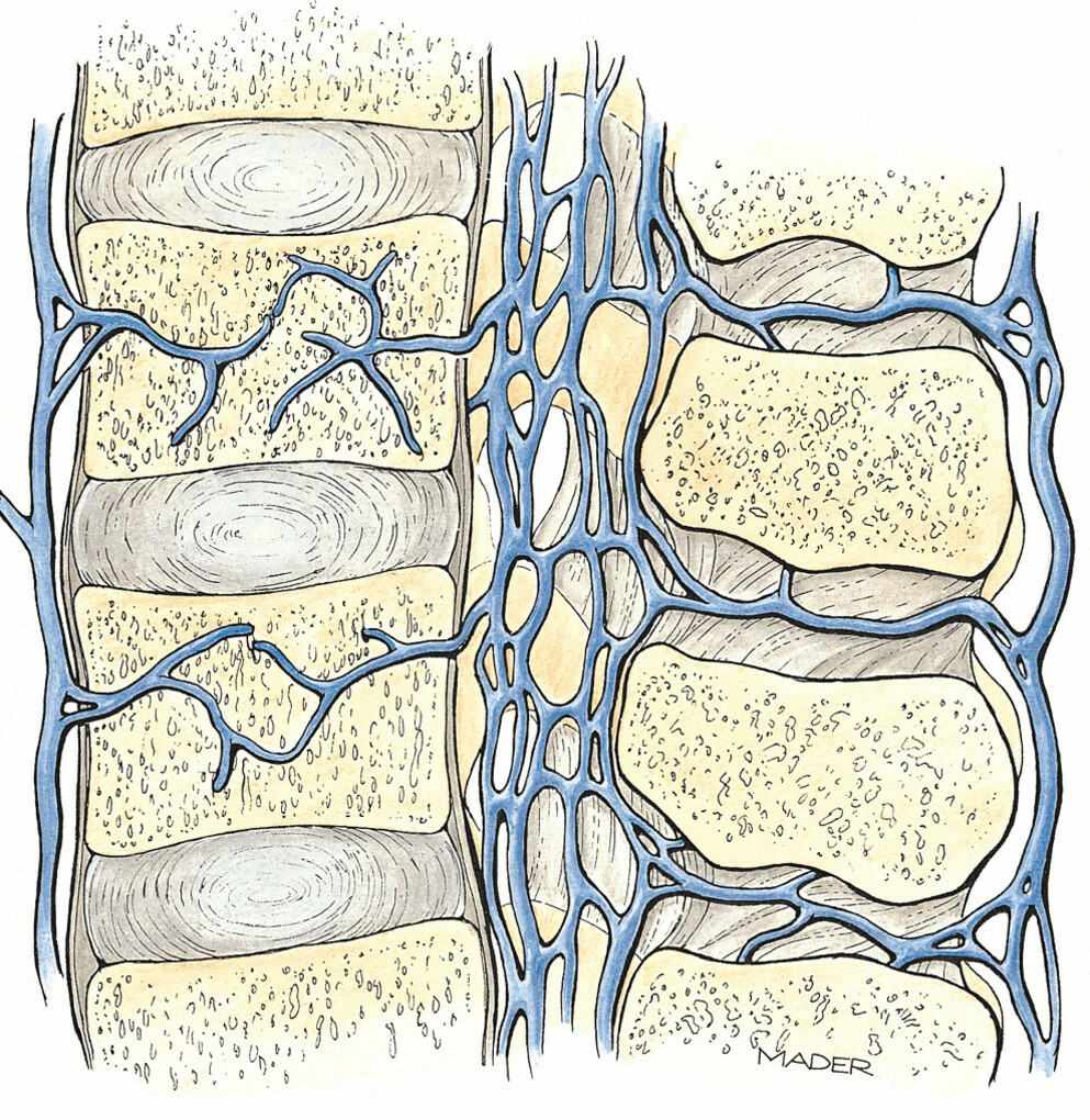 Median Section Of The Vertebral Venous Plexuses Of The Lumbar Spine Including The Basivertebral 0065